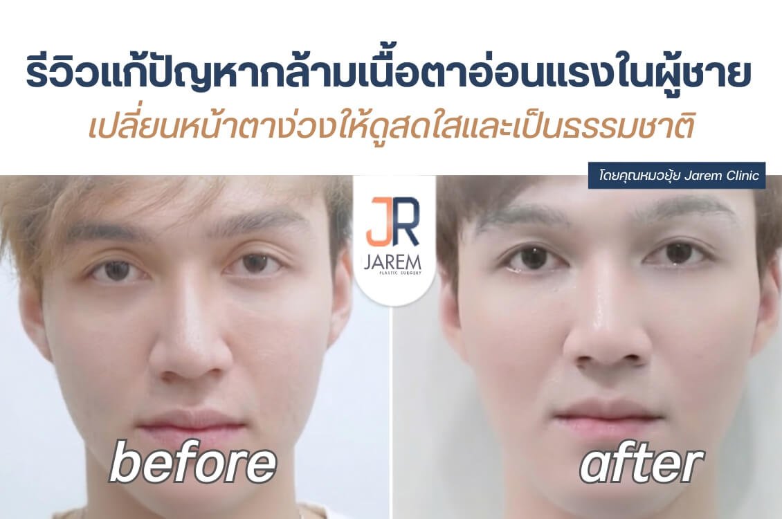 รีวิวแก้กล้ามเนื้อตาอ่อนแรงผู้ชาย เปลี่ยนหน้าง่วงให้สดใส เป็นธรรมชาติ โดยหมอยุ้ย Jarem Clinic