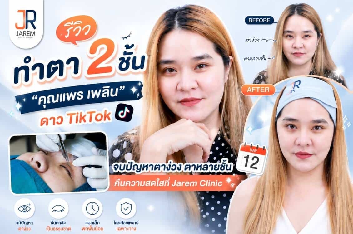 รีวิวทำตา 2 ชั้น แก้ปัญหาตาง่วง-ตาหลายชั้น คืนความสดใสในวัยใกล้ 40 สไตล์ธรรมชาติ โดยคุณแพร เพลิน