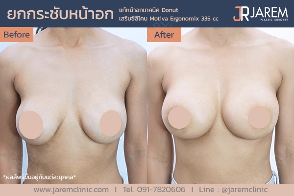 รีวิวการผ่าตัดยกกระชับหน้าอกจาก Jarem Clinic