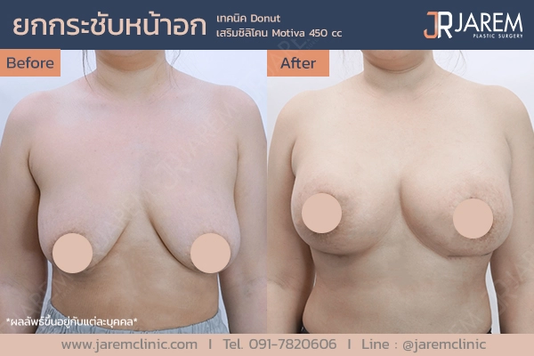 รีวิวการผ่าตัดยกกระชับหน้าอกจาก Jarem Clinic