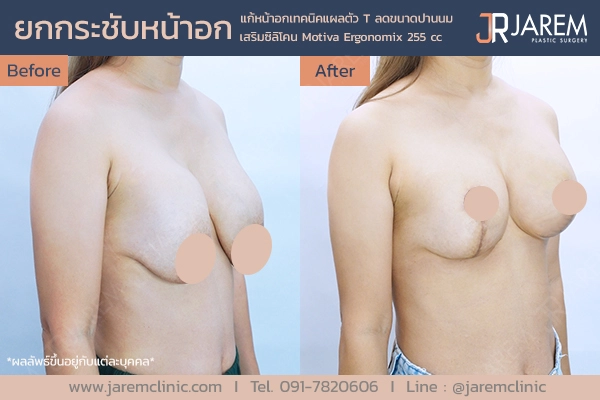 รีวิวการผ่าตัดยกกระชับหน้าอกจาก Jarem Clinic