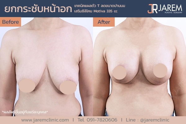 รีวิวการผ่าตัดยกกระชับหน้าอกจาก Jarem Clinic