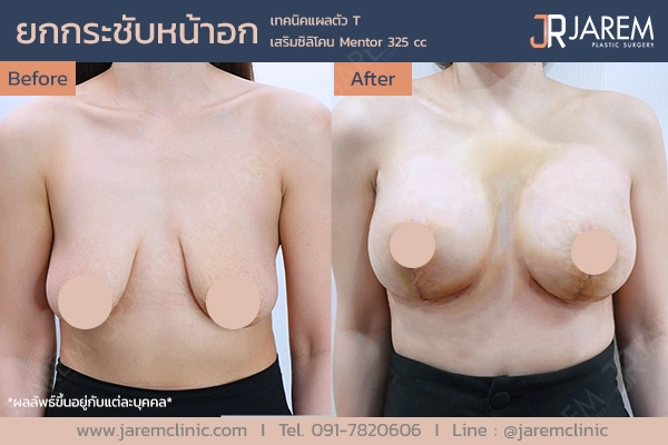 รีวิวการผ่าตัดยกกระชับหน้าอกจาก Jarem Clinic