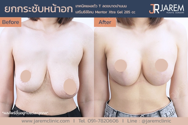 รีวิวการผ่าตัดยกกระชับหน้าอกจาก Jarem Clinic