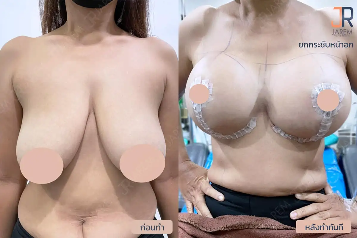 รีวิวการผ่าตัดยกกระชับหน้าอกจาก Jarem Clinic