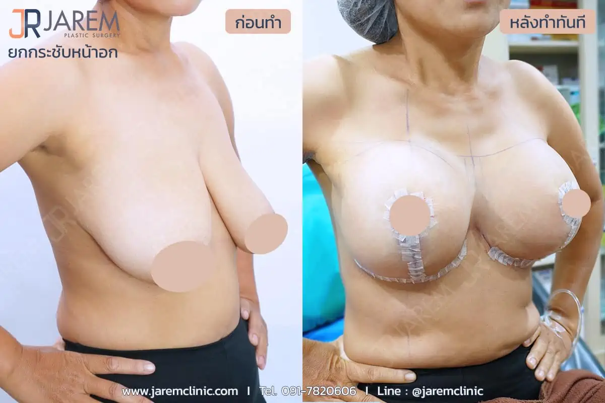 รีวิวการผ่าตัดยกกระชับหน้าอกจาก Jarem Clinic