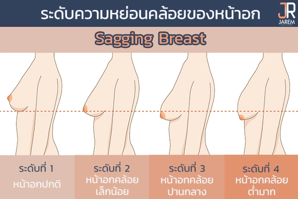 ระดับความหย่อนคล้อยของหน้าอก