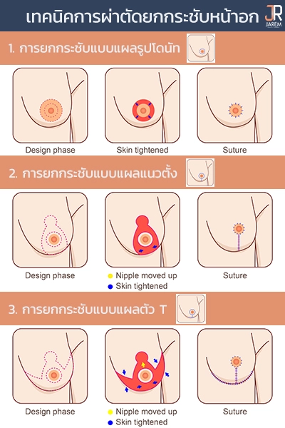 เทคนิคการผ่าตัดยกกระชับหน้าอก