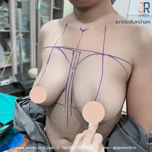 ขั้นตอนการวาดออกแบบยกกระชับทรวงอก