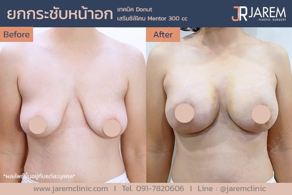 รีวิวการผ่าตัดยกกระชับหน้าอกจาก Jarem Clinic