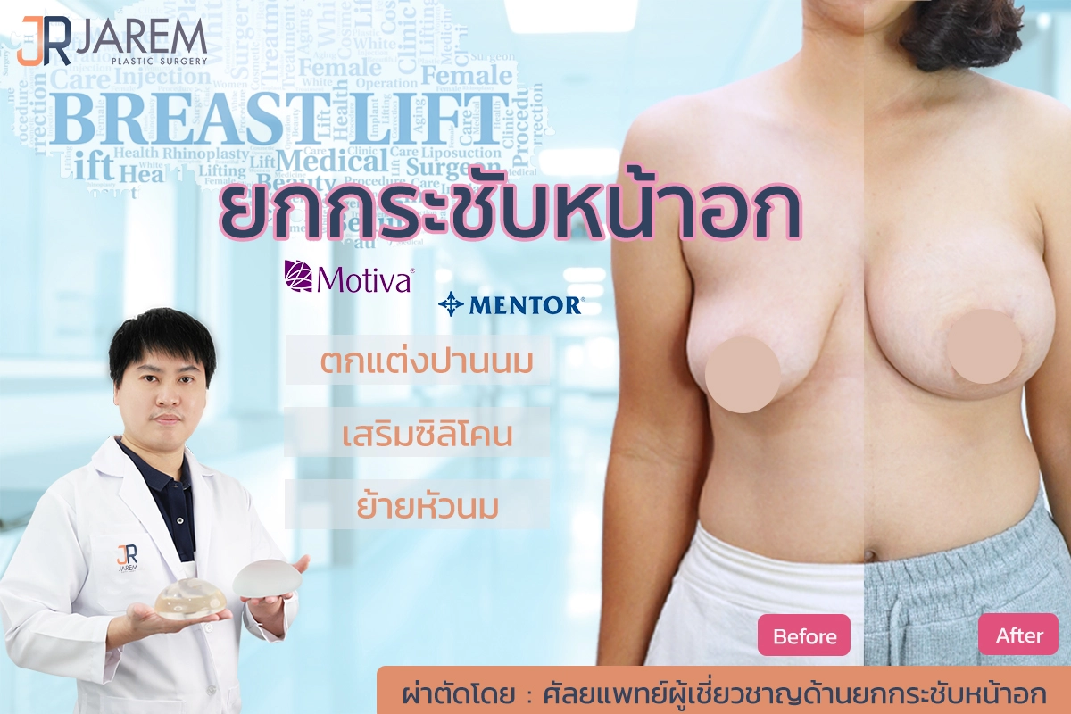 ปกบทความ Mastopexy