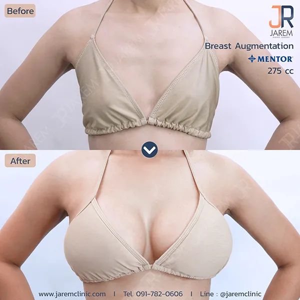 เสริมหน้าอก