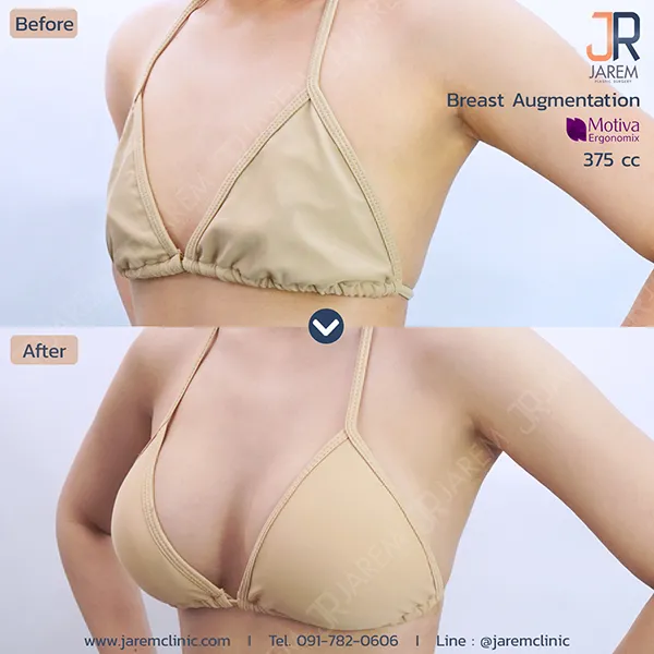 ทำหน้าอก 375cc