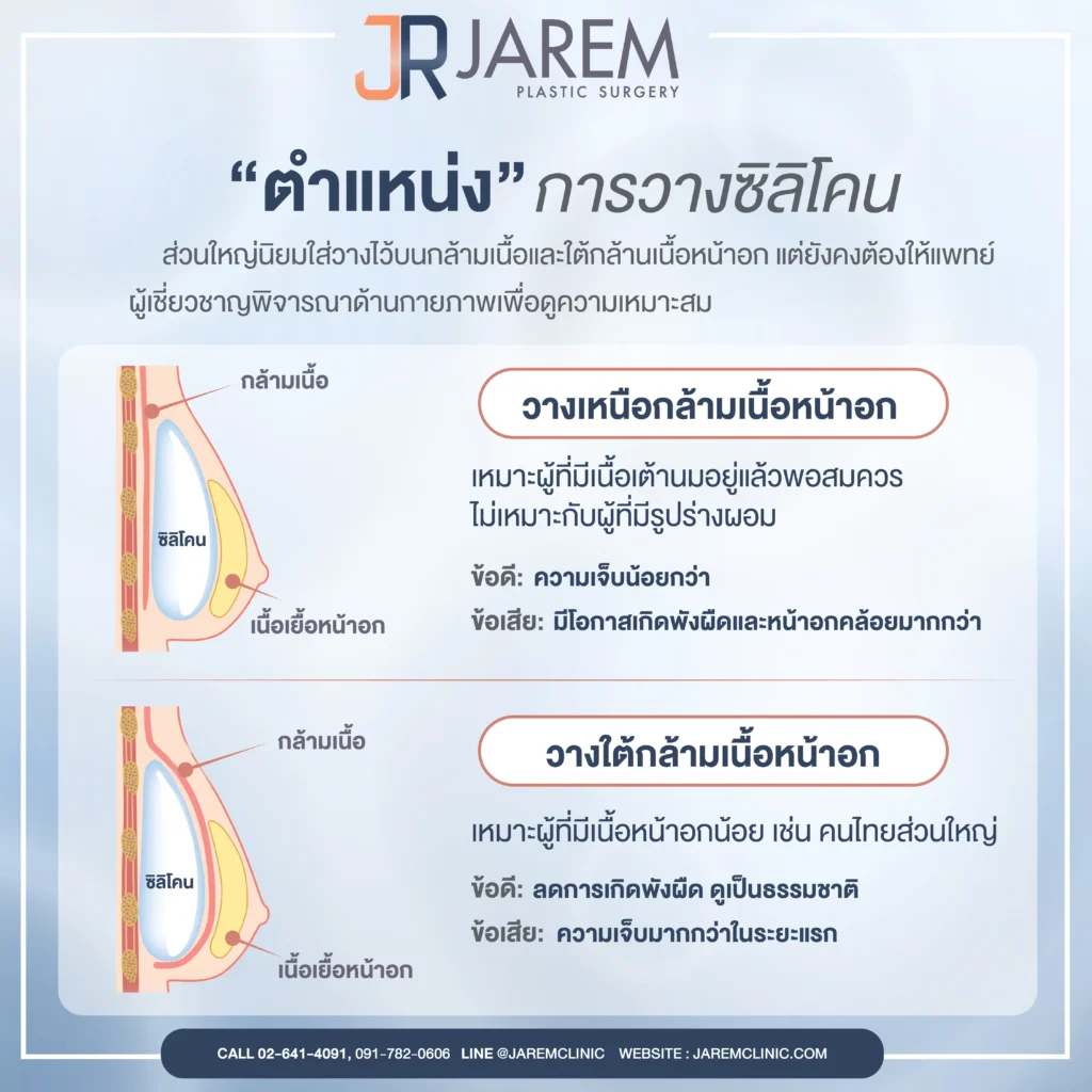 ตำแหน่งการวางซิลิโคนหน้าอก