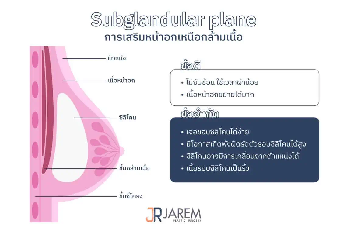 การเสริมหน้าอกเหนือกล้ามเนื้อ