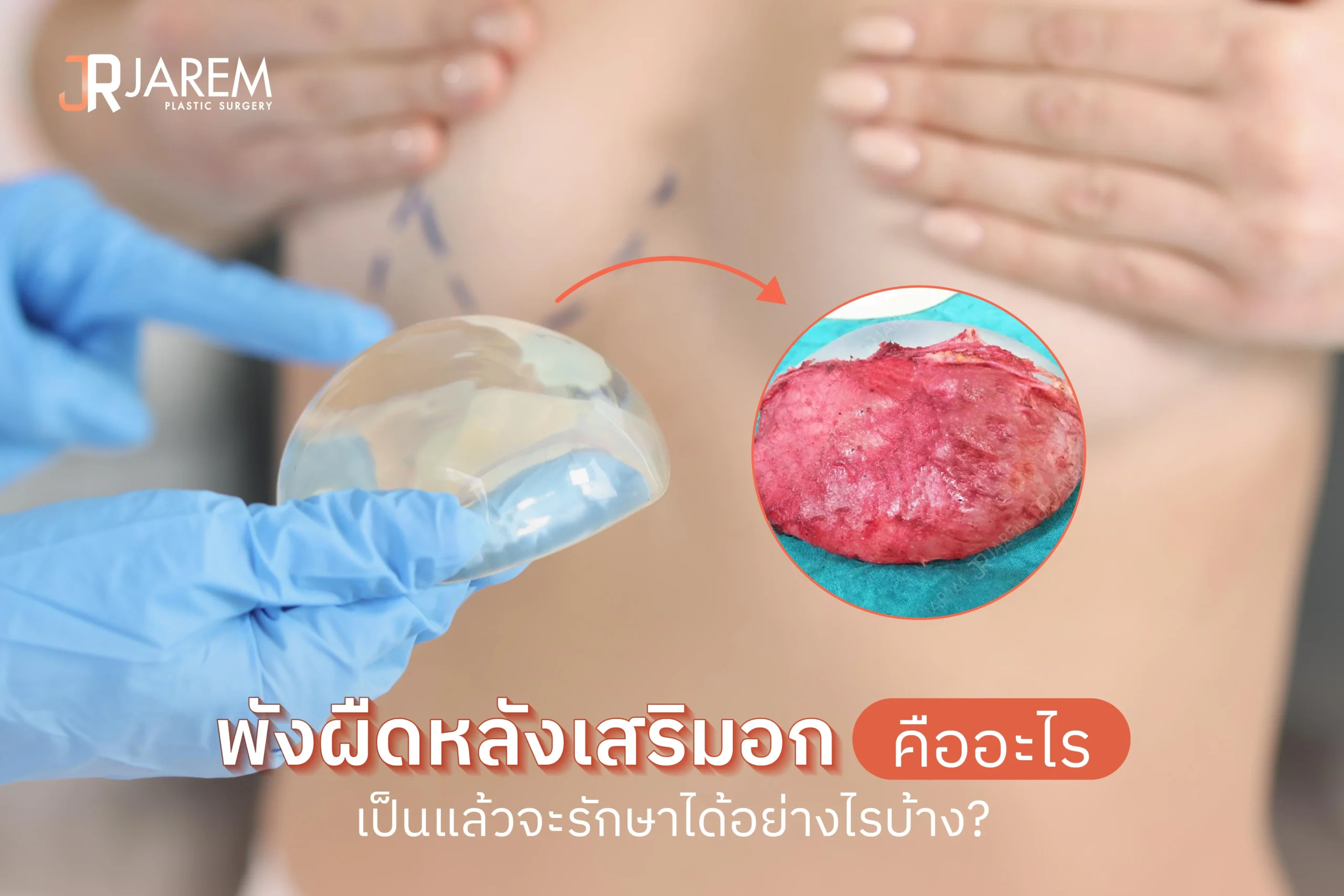 ปกบทความพังผืดเกาะซิลิโคนเสริมหน้าอก