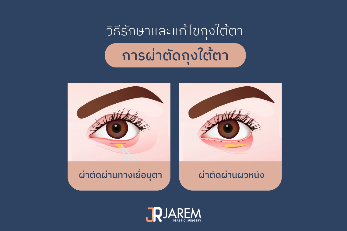 ผ่าตัดถุงใต้ตา