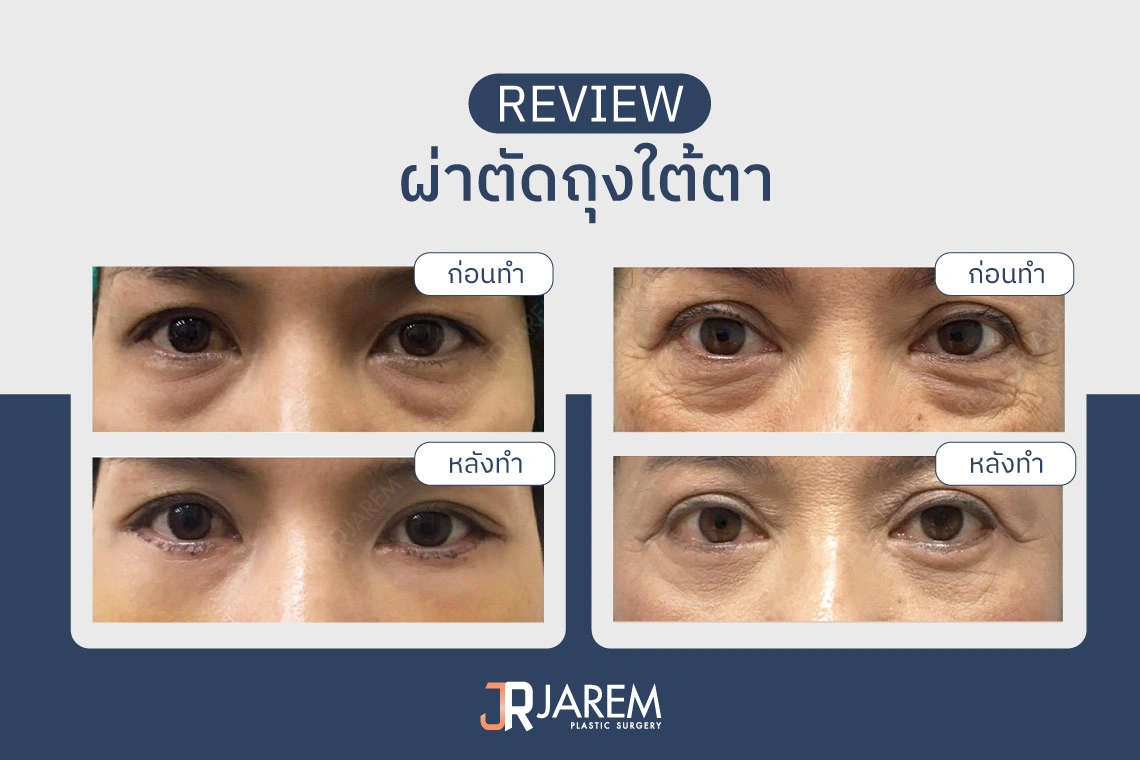 รีวิวผ่าตัดถุงใต้ตา