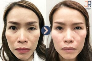 ตาหลายชั้น ตาตก 1 ข้าง แก้ไขยังไง? ผ่าตัดได้หรือไม่