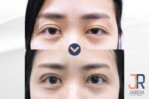 อยากแก้ตาสองชั้นต้องดู ..รีวิวแก้ตา จาเรมคลินิก