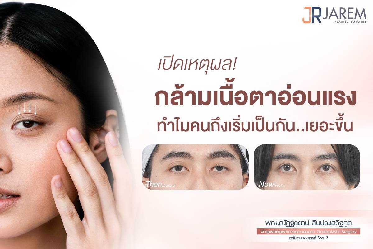 เปิดเหตุผล กล้ามเนื้อตาอ่อนแรง ทำไมคนถึงเริ่มเป็นกันเยอะขึ้น